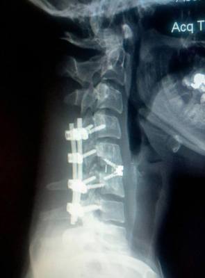 Crash Victim's X-Ray